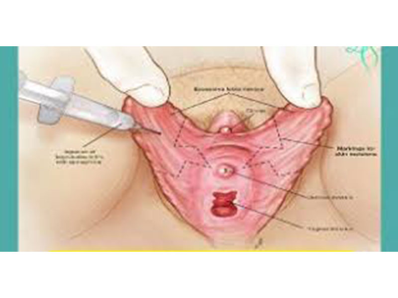 جراحه الاشفار المهبل